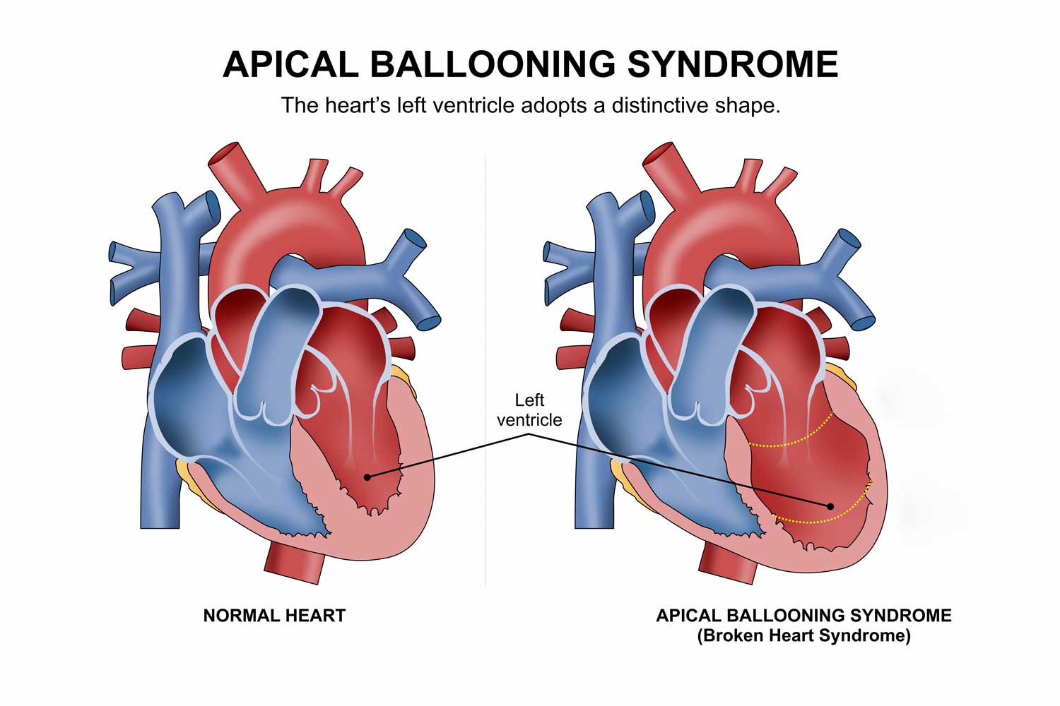 broken-heart-syndrome-illustration-sm.jpg