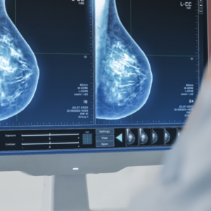 Do I Really Need a Mammogram? Understanding Breast Cancer Detection and Screening  